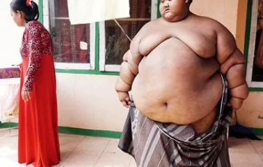 World's fattest boy undergoes incredible transformation after losing some weight. 46